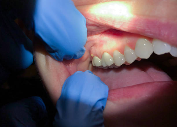 Best Broken or Chipped Tooth Repair in Riner, VA